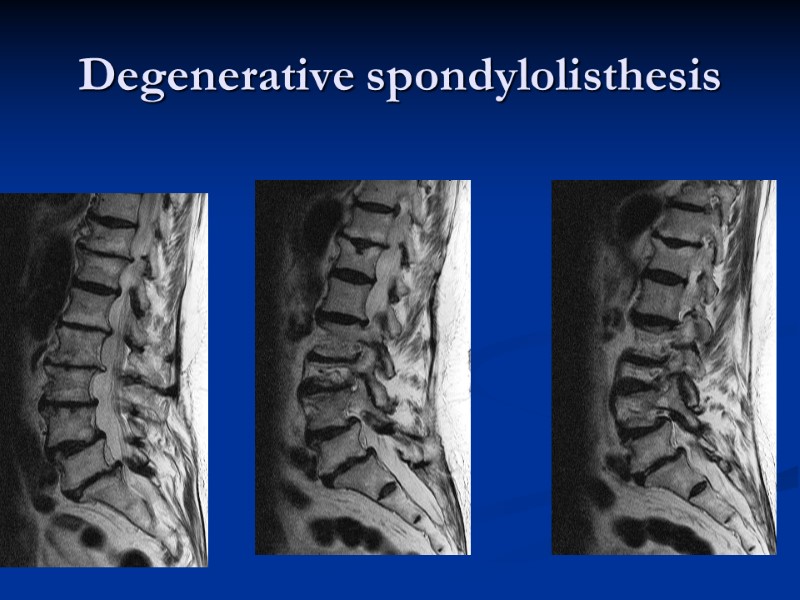 Degenerative spondylolisthesis